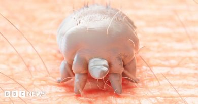 Scabies outbreak at Prince Philip hospital closes wards