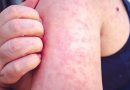 Canada’s 2-year measles outbreak officially over: PHAC – National
